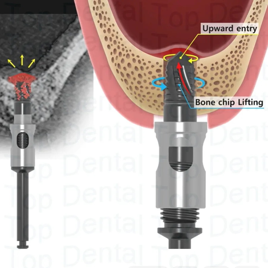

Crestal Drill Sinus Lift Drill Compitable with Dentium DASK simple kit Safety Drill