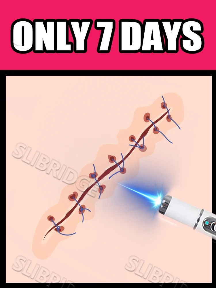 

2025Generation-2,Blue light pen Solve scar Tool