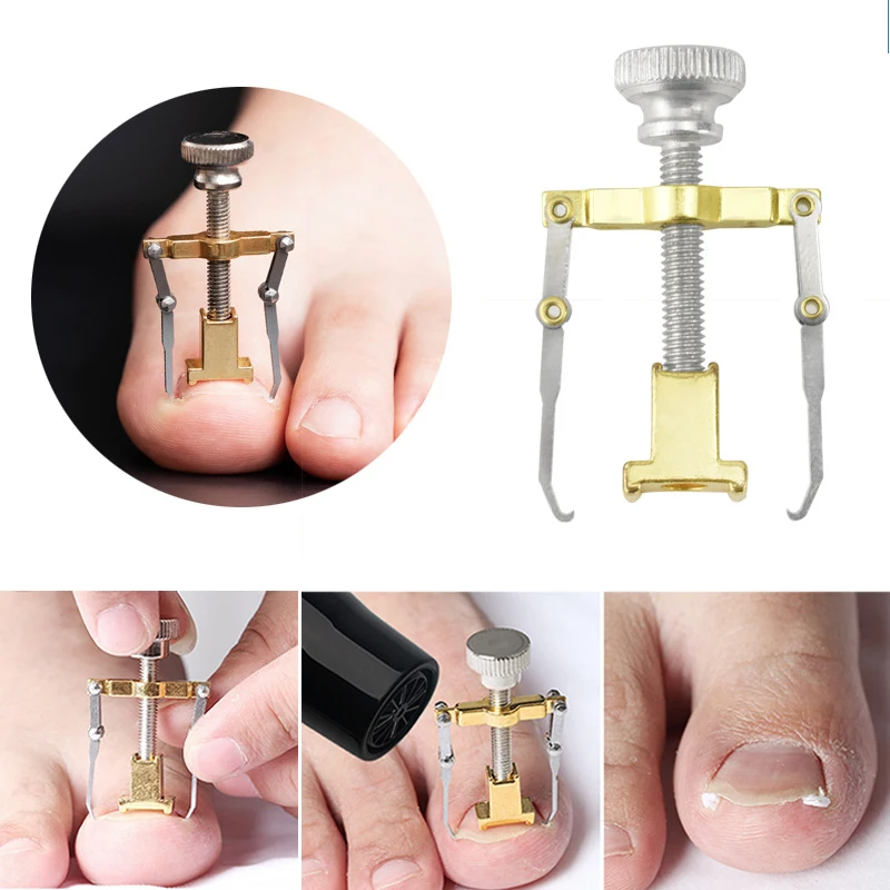 Nail Straighten Clip Ingrown Pedicure Tool Toenail Corrector Clip Cure Ingrown Toenails Health Care Relief Pain Stainless Steel