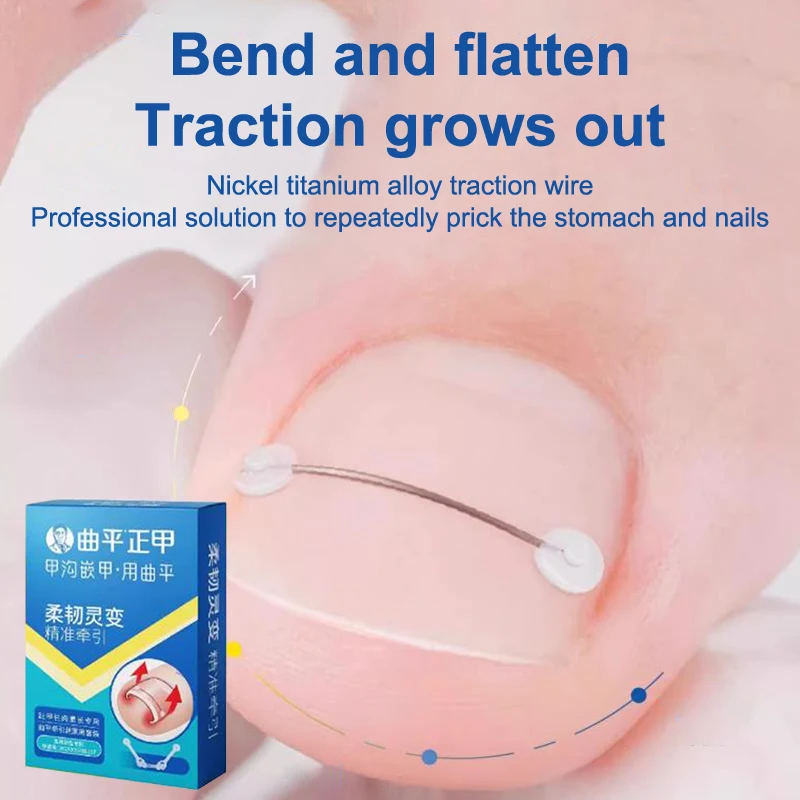 Professional Ingrown Toenail Straightening Clip Brace Ingrown Toenail Corrector Tools Pedicure Recover Embed Toe Nail Treatment