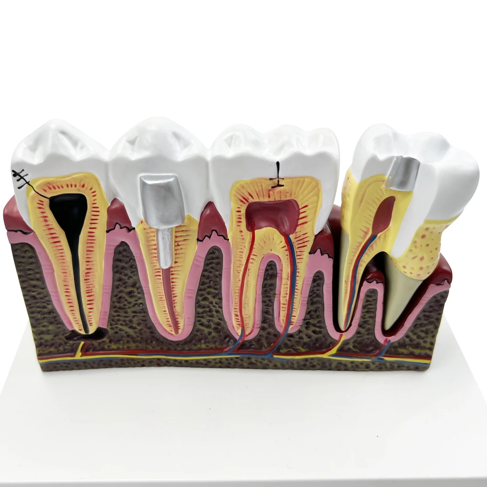 Removable Teeth Anatomy Models Detail Structure Demo Dental Anatomical Models For Clinics Dentist-Patient Communication Teaching