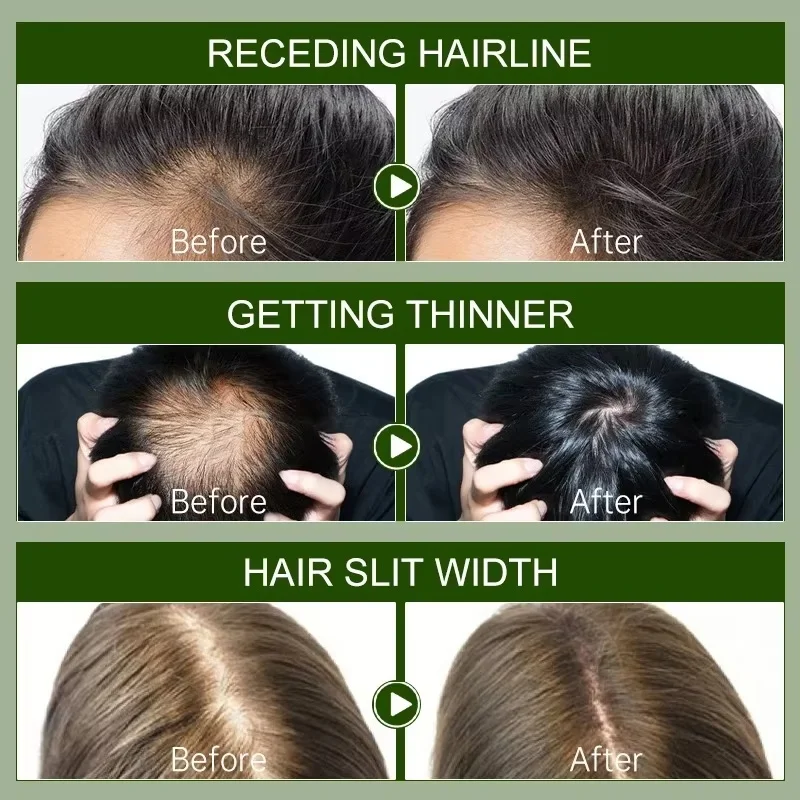 Haarwachstumsserum, 7 Tage schnelles Nachwachsen, ätherisches Kapsel, Anti-Haarausfall, Haarausfall, Reparatur beschädigter Kopfhaut, Behandlung für Frauen und Männer