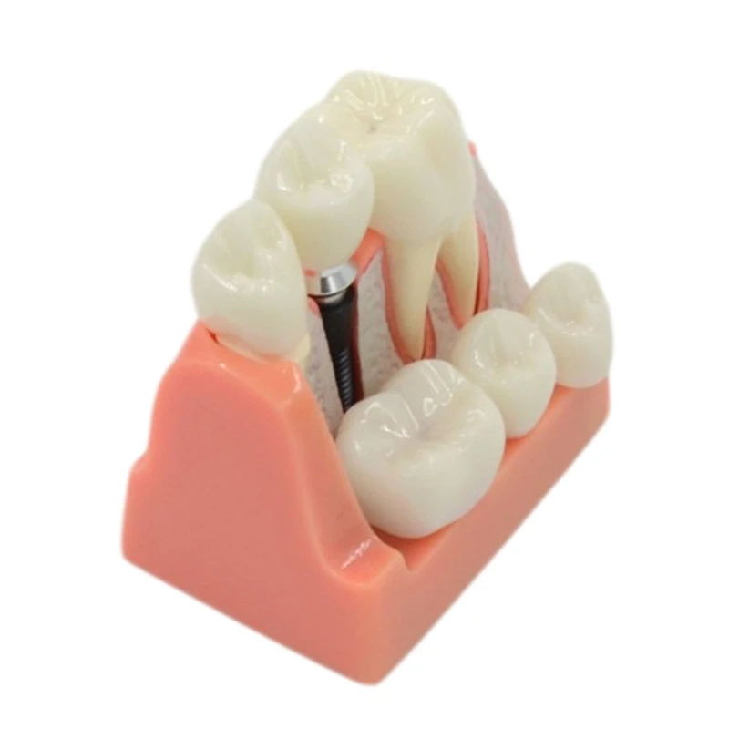 

Dental Implant Teeth Model Disassemble for Dentist Doctor-patient Communication