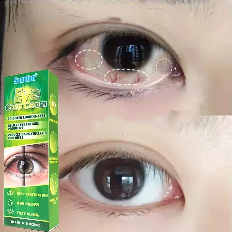 Sumifun 20 g chinesische Kräutermedizin, Augenpflegecreme, heller aussehende Augen, lindert Ermüdung der Augenprobleme, Augen, rotes Blut, klar