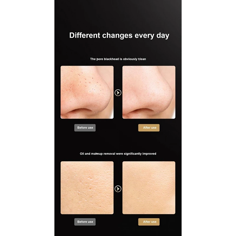 Instrument de beauté pour nettoyer les pores, Ion Peeling, lumière rouge et bleue, thérapie photonique LED, élimine les points noirs