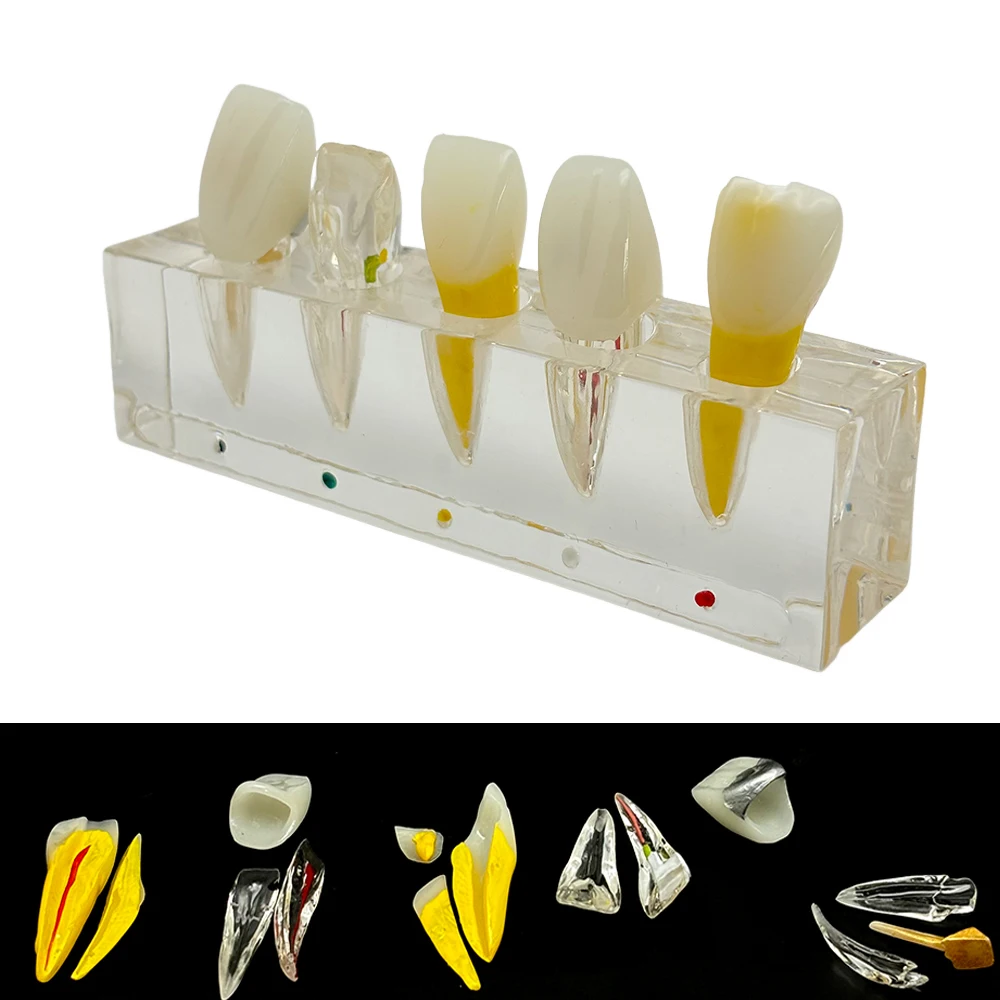 Dental Teeth Model Endodontic Treatment Model Root Canal Treatment Model Dentistry Endo Model Lab Material