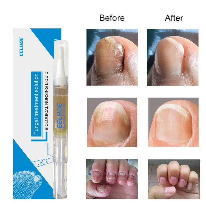 Lápiz líquido para reparación de hongos en las uñas, Gel de reparación de onicomicosis, paroniquia, antiinfección, eliminación de hongos en los dedos de los pies y manos