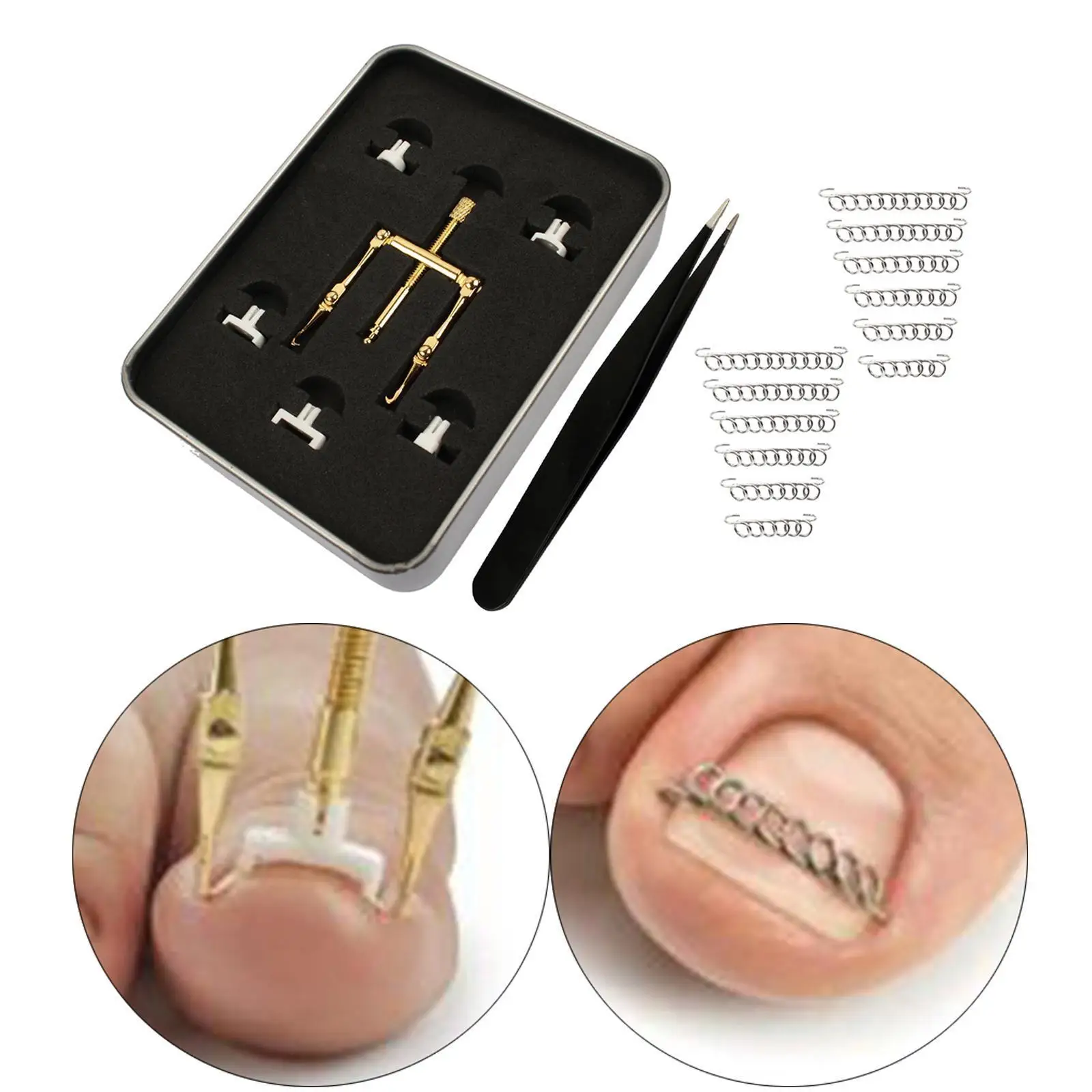 علاج أظافر القدم الغارزة، مشبك تنعيم للأظافر