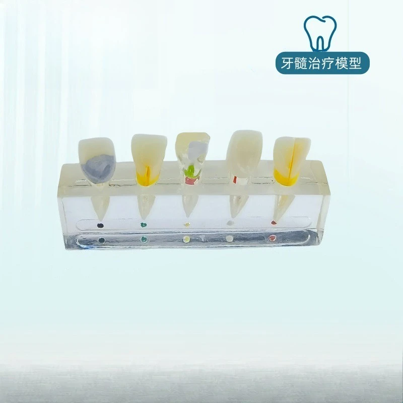 Doctor-patient communication pathology model, dental sui disease restoration model, display pulp, dental sui treatment model