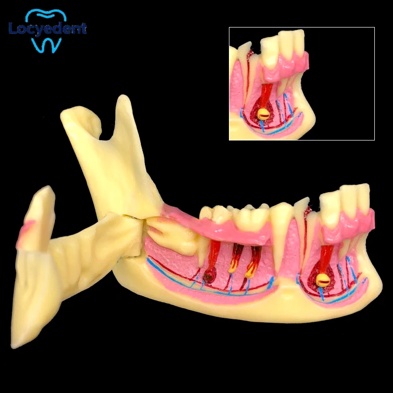 

Модель нижней челюсти с зубами для изучения анатомии, демонстрации импакции, карии и абсцесса, для обучения в стоматологических клиниках ﻿