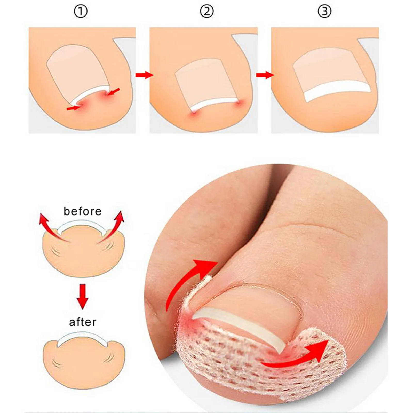 10Pcs/30Pcs/50Pcs/100Pcs Special tools for ingrown nails, breathable bandages, suitable for foot, hand and nail care-For Adults