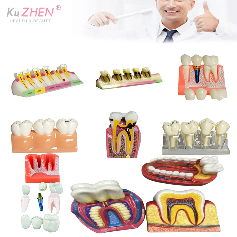 1PC Dental Caries Display Model Disease Teeth Dental Model For Dental Demonstration Teaching Model Training Aid Clinic Ornaments