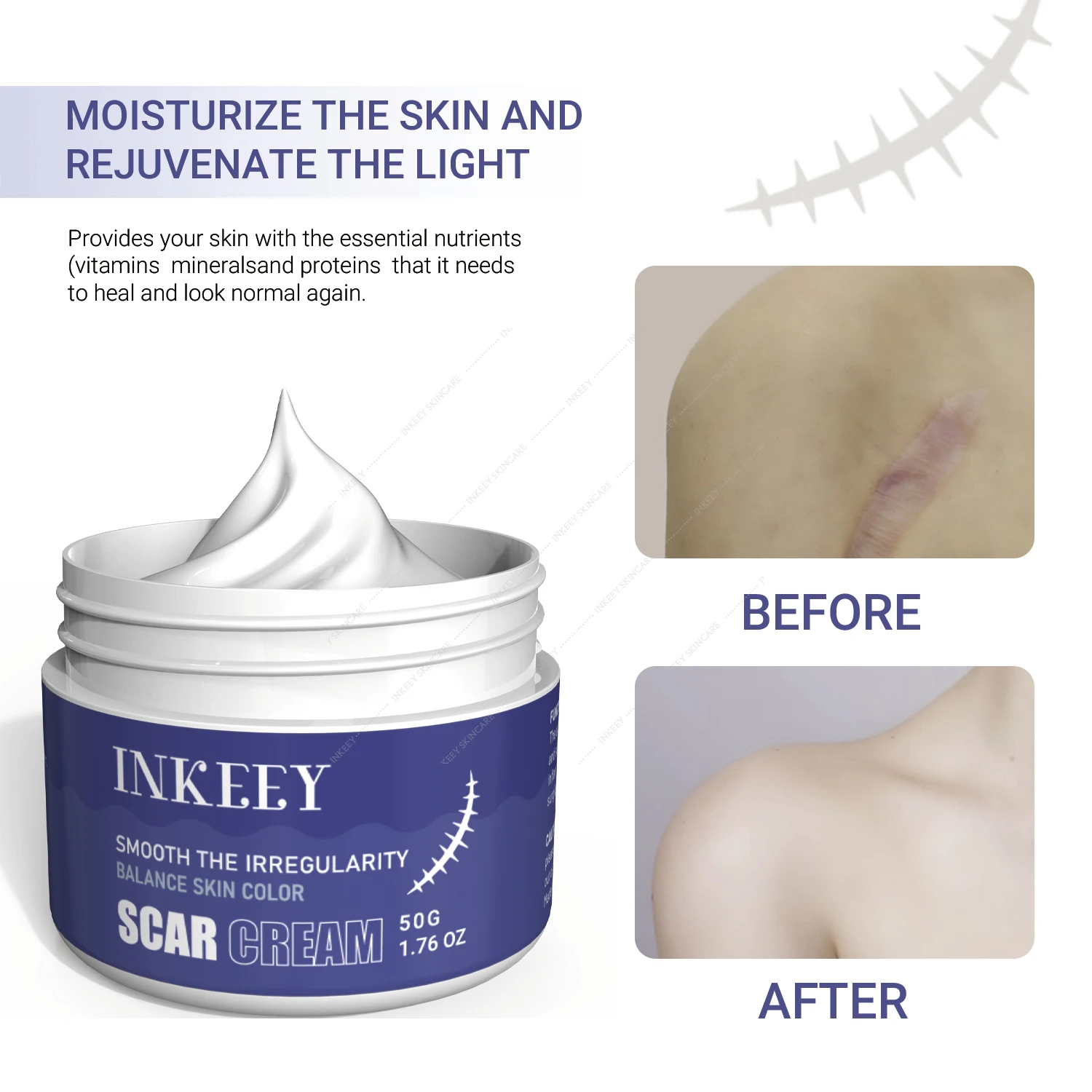 Scar Removal Cream Fade Acne Scar Spots Treatment Stretch Marks Burn Surgical Scar Repairing Cream New Old Scars Gel Skin Care