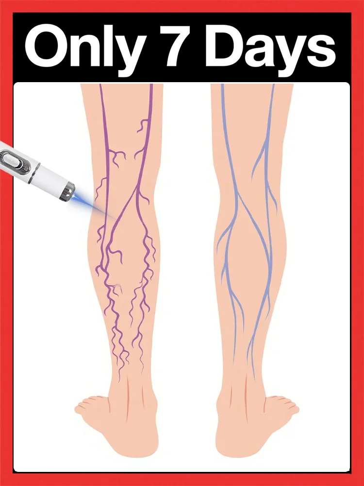 

Stylo laser à lumière bleue, ensemble d'outils universels pour le soin des jambes