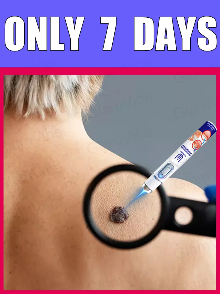 

blue light pen solve warts, hot sale wart care tools