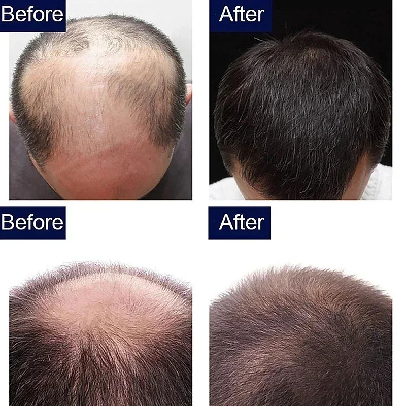 Soro de crescimento rápido do cabelo para homens e mulheres, anti-perda, cabelo rebrota produtos, reparação danificado cabelo raízes, cuidados com o cabelo, 7 dias, Batana