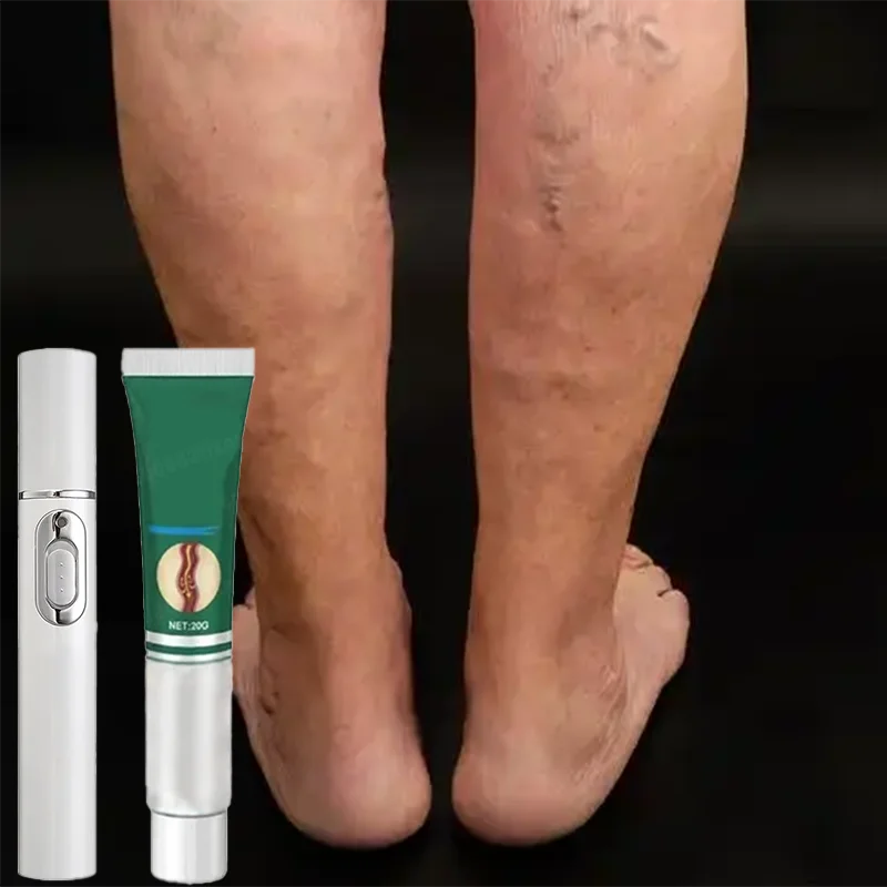 

Устройство для светотерапии варикозного расширения вен | Лампа для поддержки кровообращения ног для видимого внешнего вида и облегчения дискомфорта