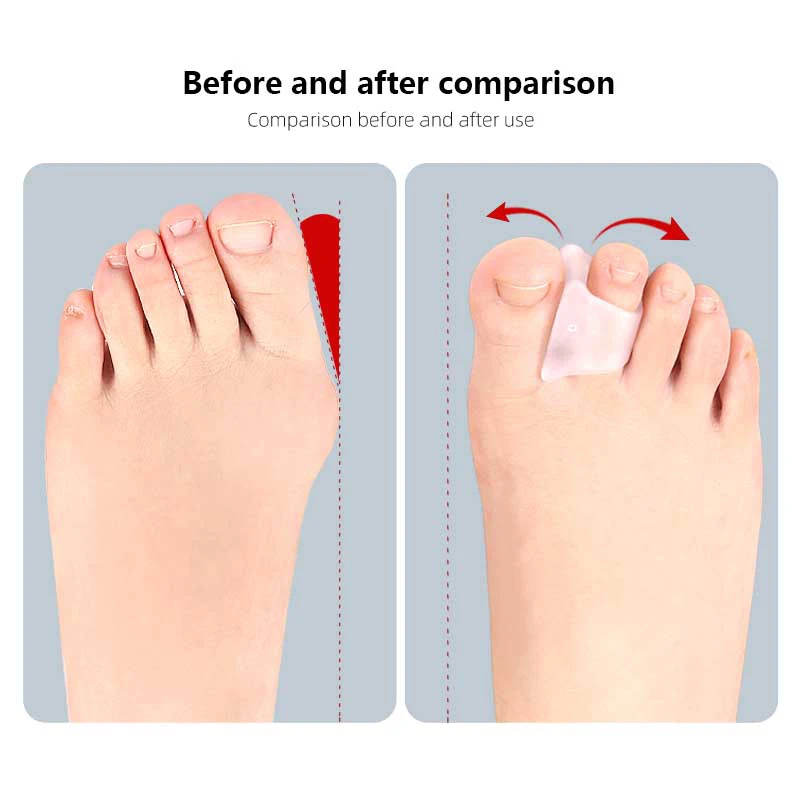 2Pcs Hammer Toe Straightener Hammertoe Corrector For Curled Crooked Bent And Claw Toes Lift Toe Tip Cushion Foot Care Tool