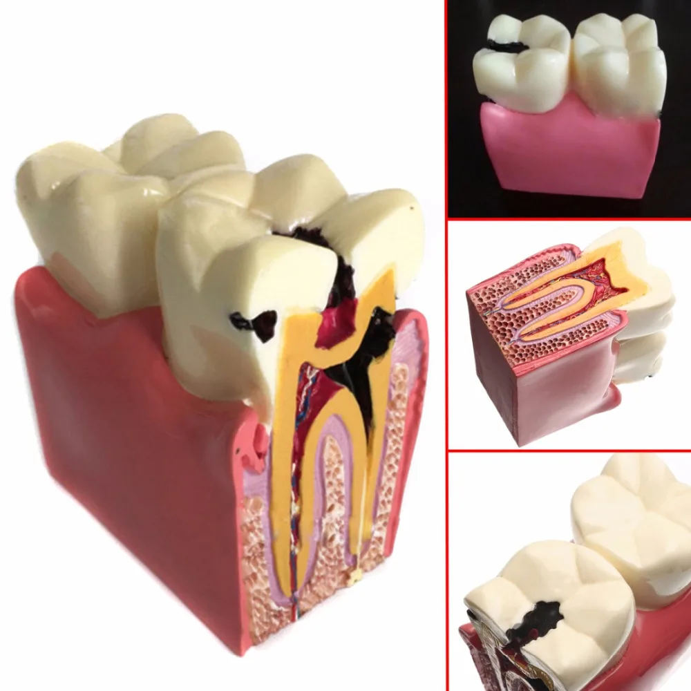 1pc 6 Times Dental Caries Comparsion Models Tooth Decay Model For Dental Study Teaching Dental Anatomy Education Teeth Model