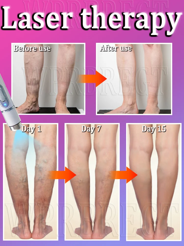 青色光レーザー治療ペン、脚の静脈瘤治療、脚のクモ状静脈治療