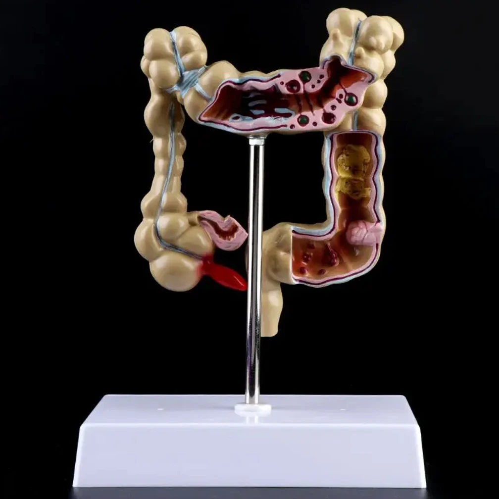 Colorectal Lesion Model Human Colon Snake Large Intestine Pathological Diseases Model Medical Organizer Anatomy Drop Shipping