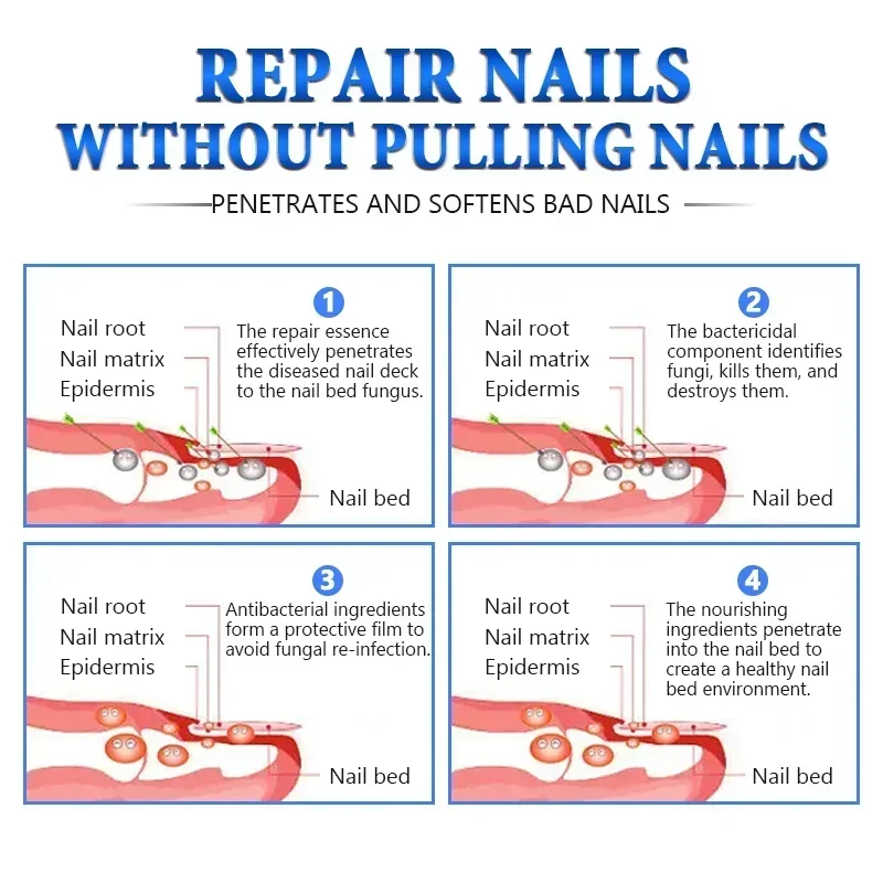 Liquide de réparation des ongles pour le renouvellement des champignons, décoloré, épaissi, écrasé, N64.F6