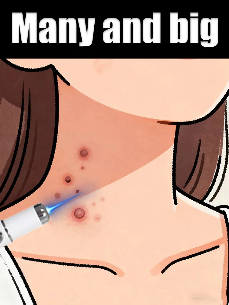 

Localized cleansing and beauty tools, wart change pen