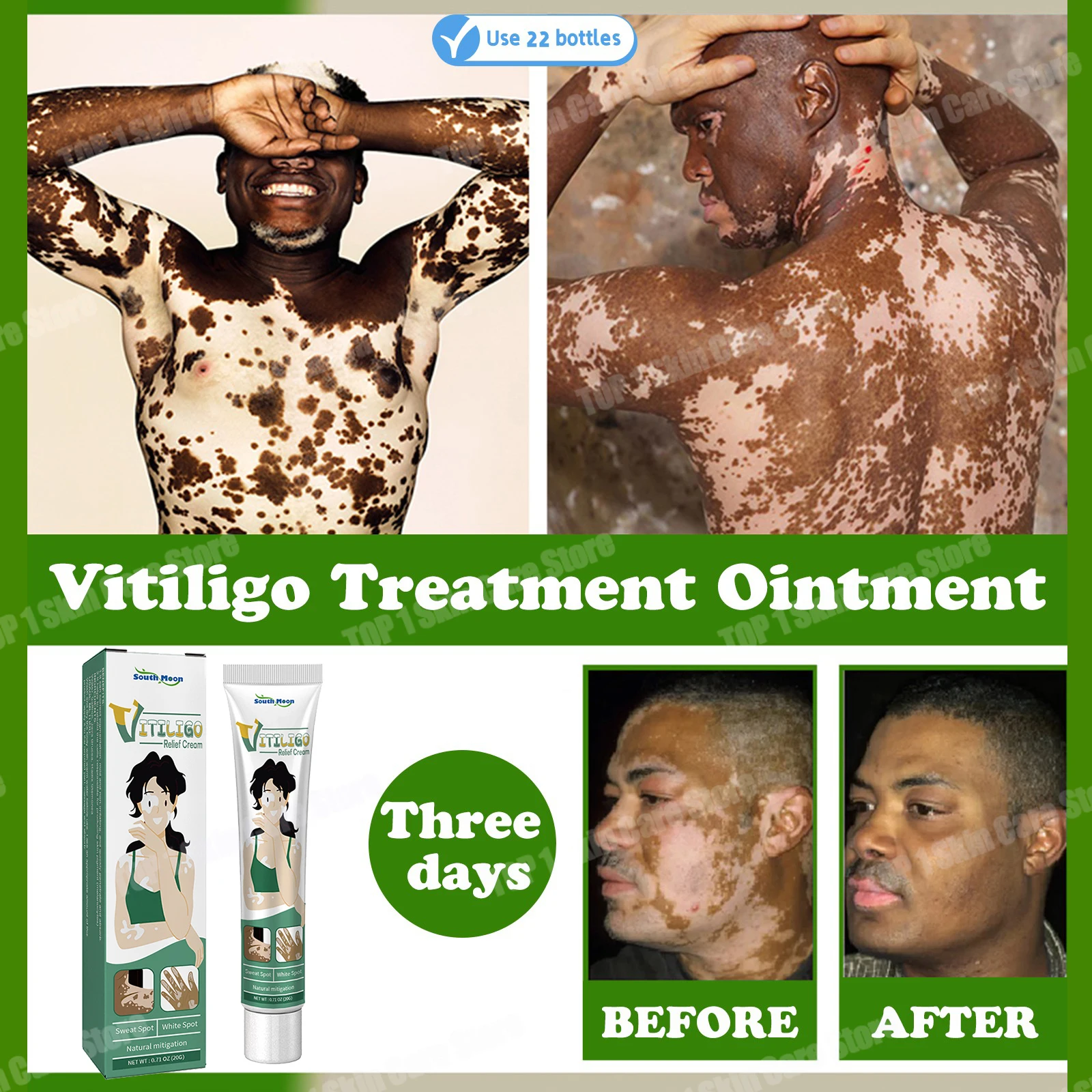 

Herbal Extract Vitiligo Ointment Remove Ringworm White Spot Removal Skin Vitiligo Eliminate Vitiligo Treatment Cream