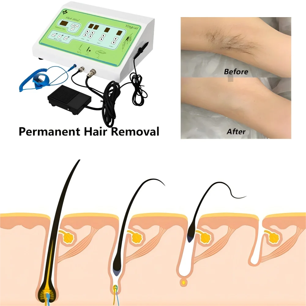 Thumbnail 2 - #48 Compare Hair Removal Devices Before You Buy