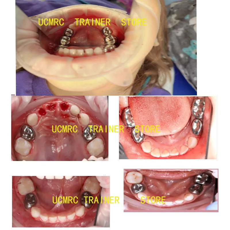 Coronas dentales de Metal preformadas para niños, de acero inoxidable molares primarios, coronas temporales, recarga superior e inferior, 1st/2nd Molar, 5 unids/lote por caja