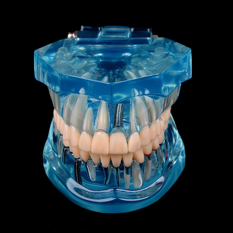 Modelo de dientes con implante Dental para enseñanza médica, cuidado de la salud Oral, ciencia, enseñanza de enfermedades dentales, gran oferta