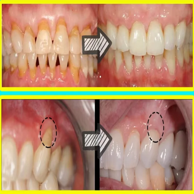 إصلاح سريع مصل اللثة تخفيف إعادة نمو اللثة قطرات تبييض الأسنان إزالة البقع البلاك الصفراء تسوس آلام الأسنان معجون الأسنان