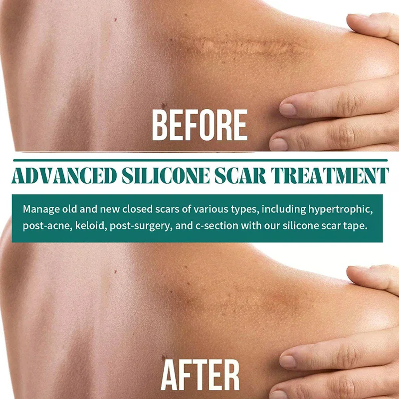1 Roll Silicone Scar Sheets Gel Scar Patch 4cmX150cm Self-Adhesive Scar Cover Tape Reusable And Effective Skin Care Strips