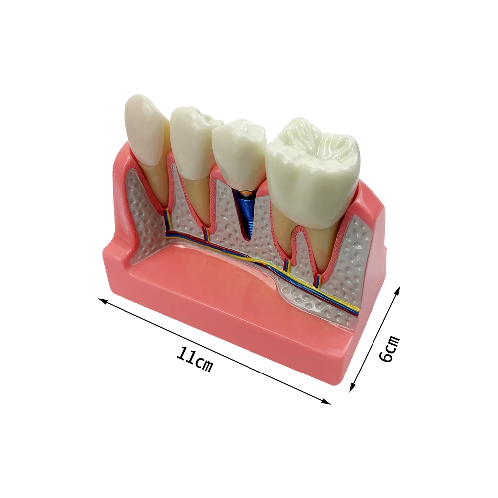 4 Times Implant Model Dental Bridges Crown Dental Teaching Model With Removable Demonstration Tools For Dentist Student Teach