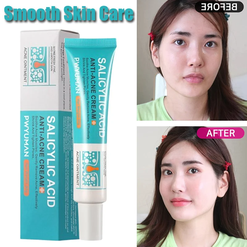 Salicylic Acid Face Cream Acne Removal Oil Control Shrink Pores Lighten Acne Marks Melanin Gel Smooth Skin Care Beauty Korea 30g