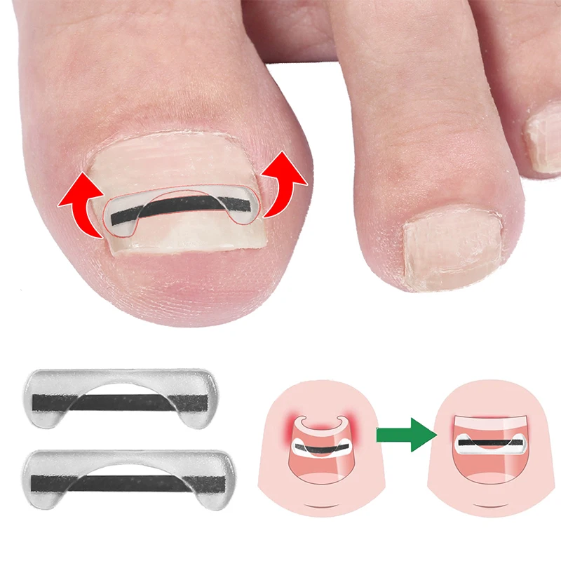 발톱 교정기 티타늄 합금 발톱 교정 와이어 자란 손톱 치료 장치 스티커 실리콘 도구 발 관리