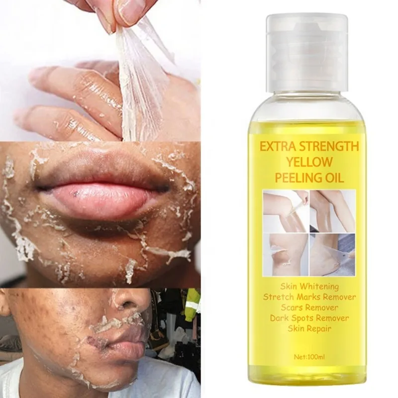 Óleo de Peeling Amarelo Super Força para Pele Negra, óleo clareador forte, removedor de pele, óleo de peeling amarelo clareador africano