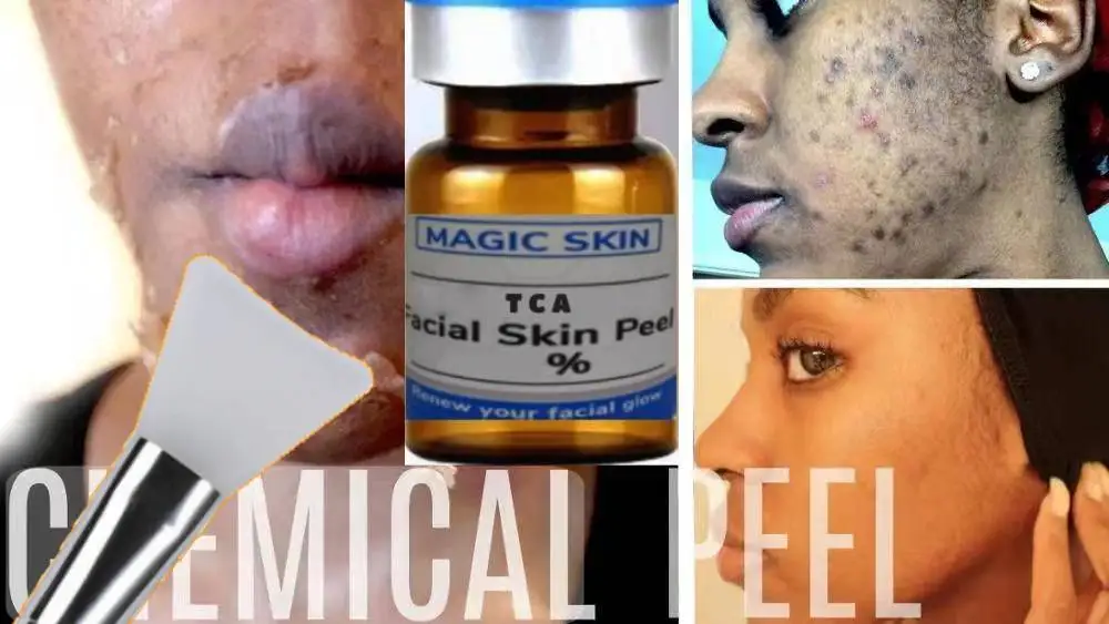 Peeling chimique pour le visage, extinction des cicatrices d'acné, taches, déformations SAP, peeling facial acide à domicile agrandi, peeling Tca