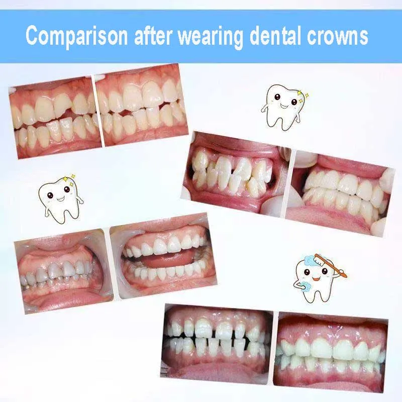 الأقواس المزيفة لتاج الأسنان وأقواس الأسنان أدوات حماية الأسنان #3