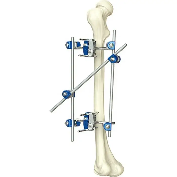 

Orthopedic surgical instruments Modular external fixator Tibial external fixator for fractures