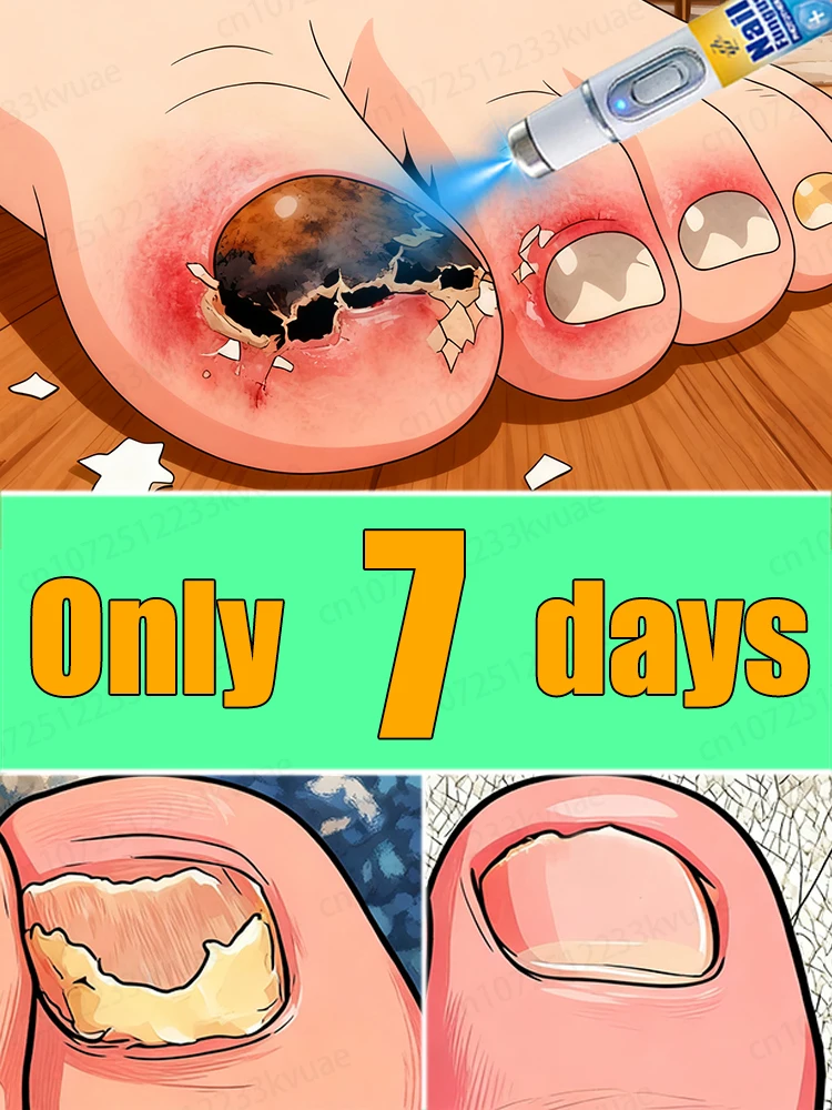 

2025 Hot Selling Product: Helps you get rid of onychomycosis