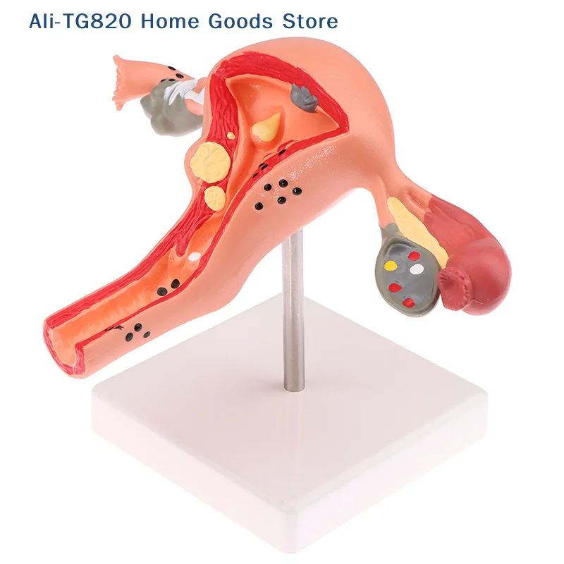 

[TG820]1Pcs Props Model Pathological Uterus Ovary Anatomical Model Anatomy Cross Section Study Tool