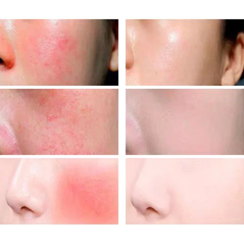 Imagen 2 del producto Crema reparadora de enrojecimiento Facial mejora la sequedad de la piel sensible crema hidratante loción calmante eliminación Rosacea Cosméticos Coreanos