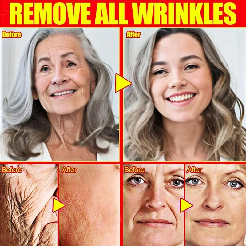 

Remove Neck Lines