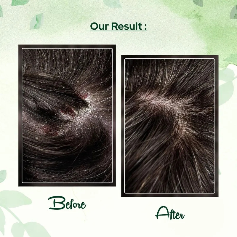 شامبو مضاد للقشرة بحمض الساليسيليك بكبريتيد السيلينيوم 200 مل للعناية بفروة الرأس والتقشير والتحكم في الزيت، نضارة تدوم طويلاً #2