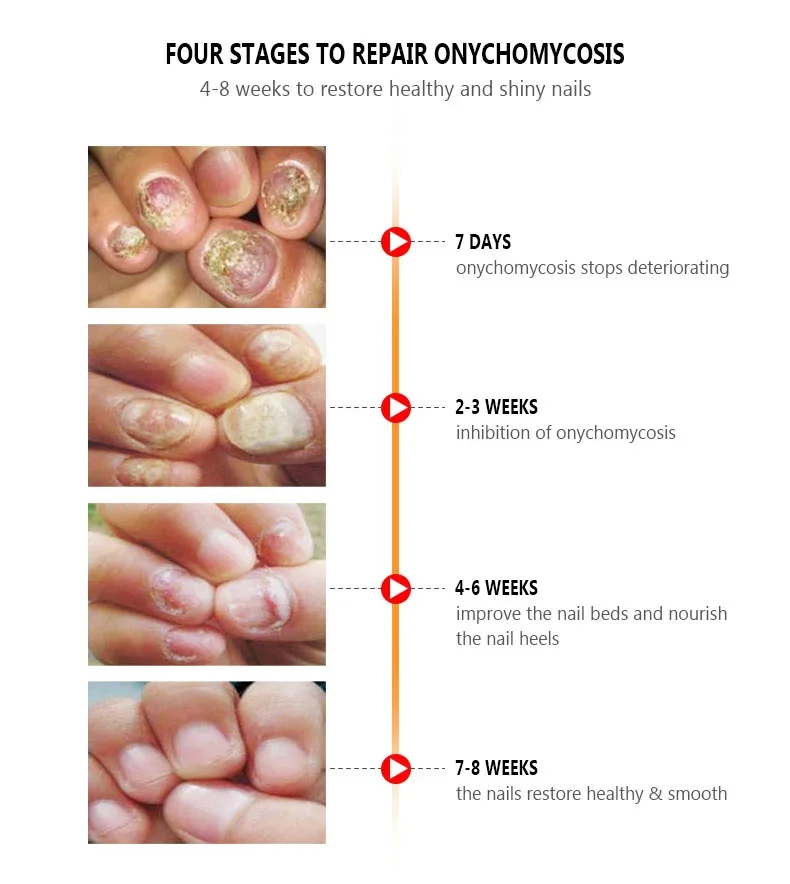 เล็บ Fungal Treatment Serum เท้าเชื้อราเล็บกําจัดน้ํามันหอมระเหย Anti Infection Onychomycosis Paronychia Repairing Care