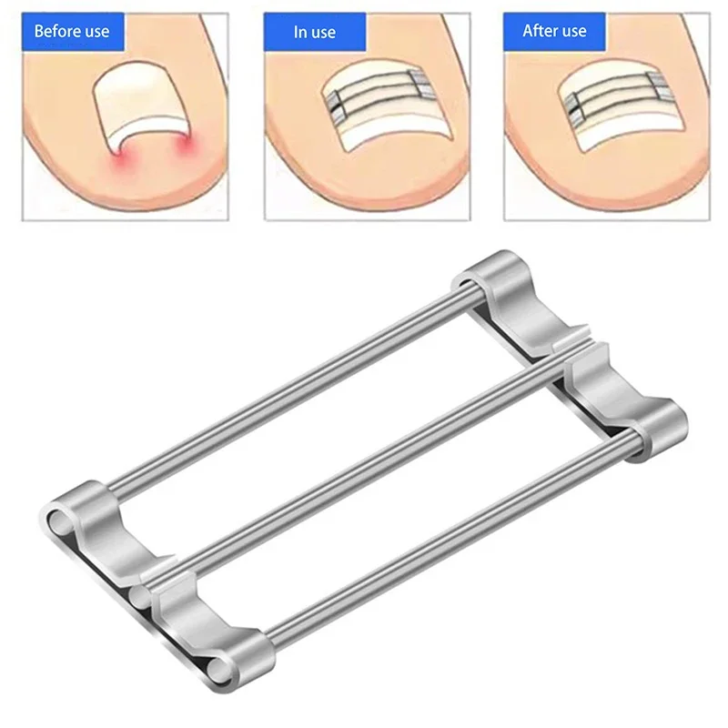 Corrector de uñas encarnadas, herramientas de sujeción, recuperación de pedicura, tratamiento de uñas encarnadas profesional, alisado de uñas encarnadas