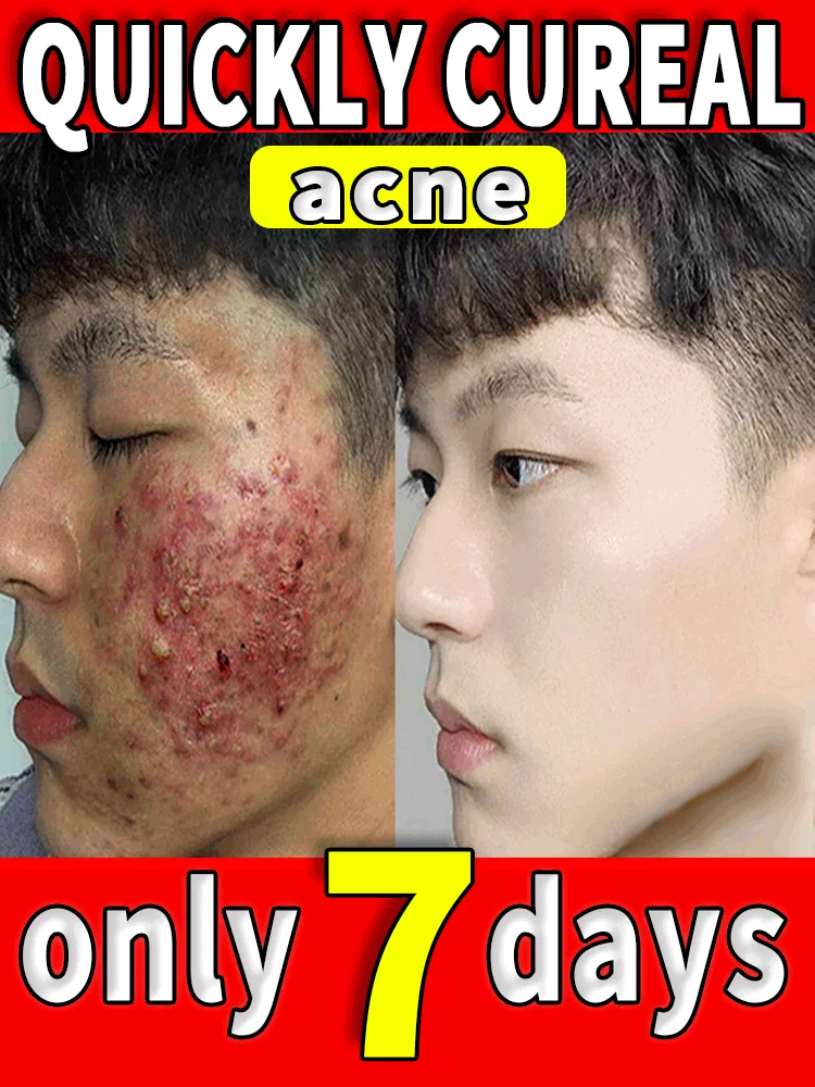 

Acne Treatment Cream For Face Scar Serum Remover Remedy