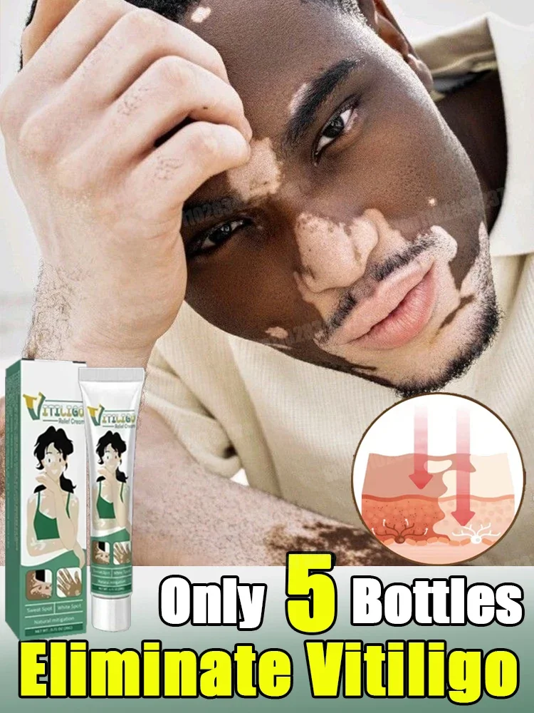 

Improve Skin Pigmentation and Reduce White Spots Vitiligo Cream New
