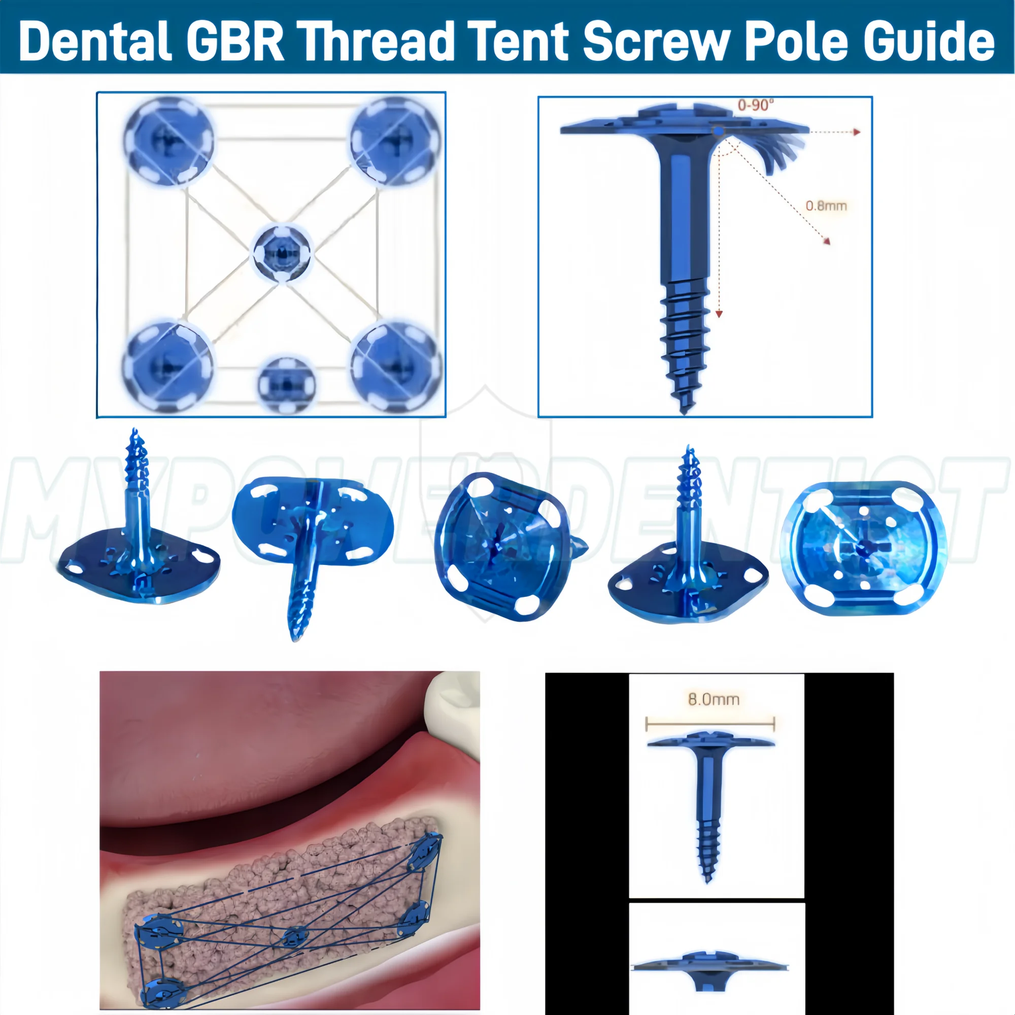 Dental GBR Thread Tent Screw Pole Guide Regeneration Tenting Wide Head 8X10mm Screws Blue Driver